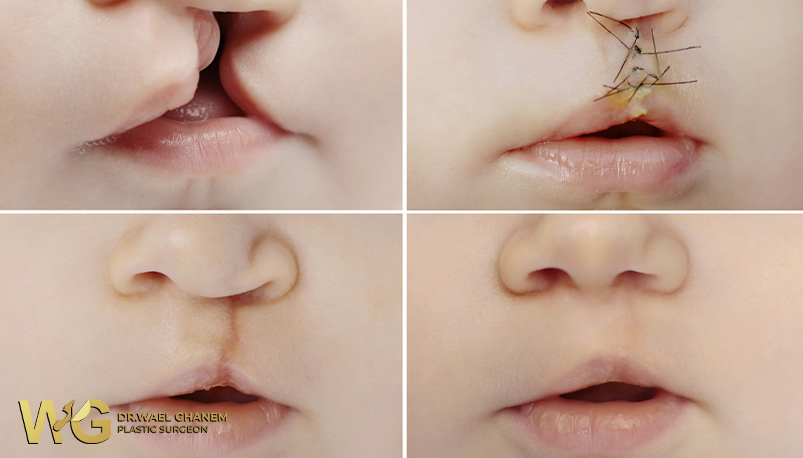 الشفة الارنبية قبل وبعد