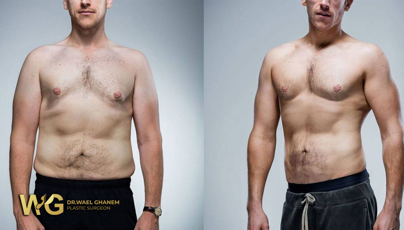 حرق دهون الثدي عند الرجال بطرق طبيعية وجراحية