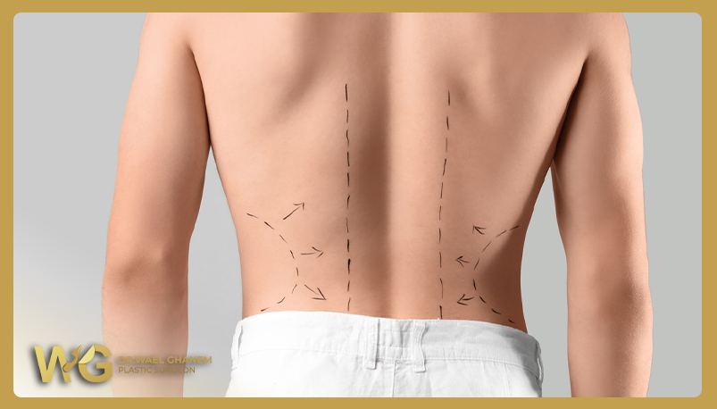 عملية نحت الظهر