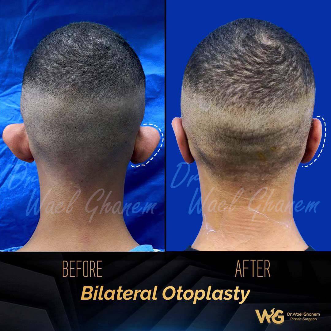 قصة نجاح لعلاج الأذن البارزة