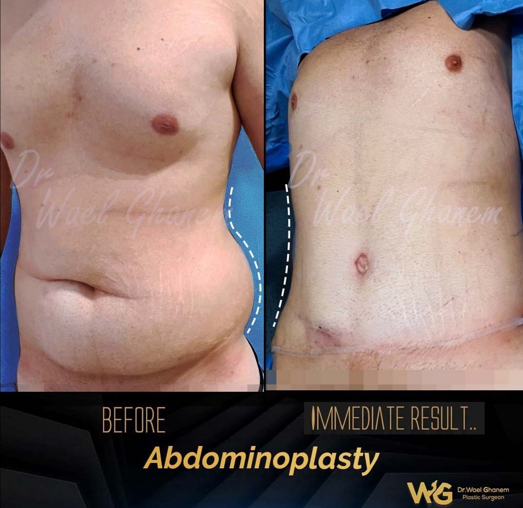 abdominoplasty