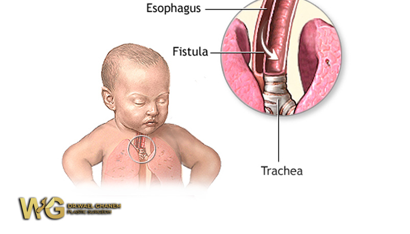 انسداد المريء عند حديثي الولادة