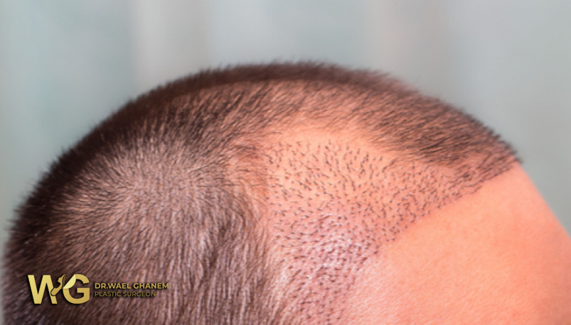 تجربتي مع زراعة الشعر