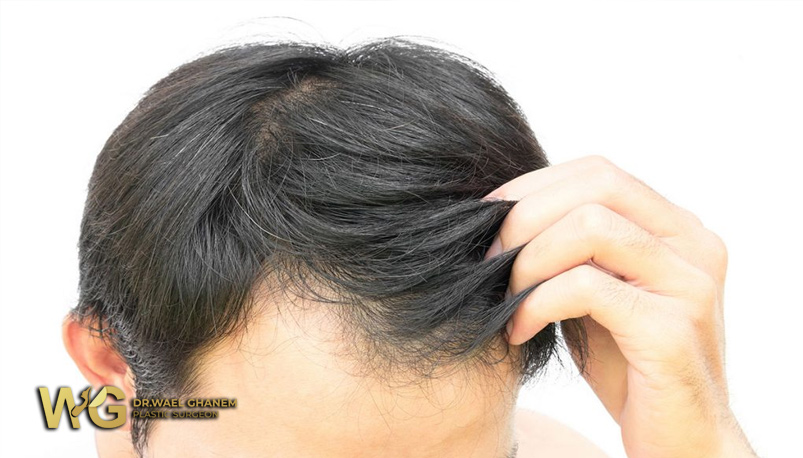 تساقط الشعر المزروع بعد العملية.. الأسباب وطرق الوقاية