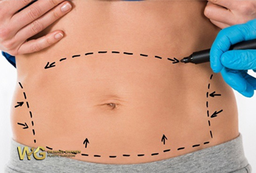 Liposculpture
