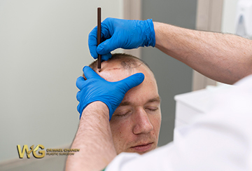Hair Transplantation