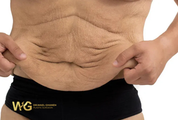 Tighten Saggy Skin
