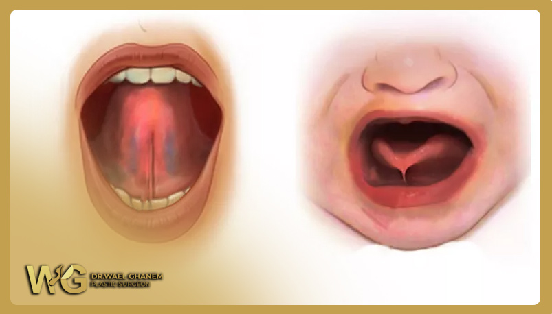 إصلاح العيوب الخلقية في اللسان