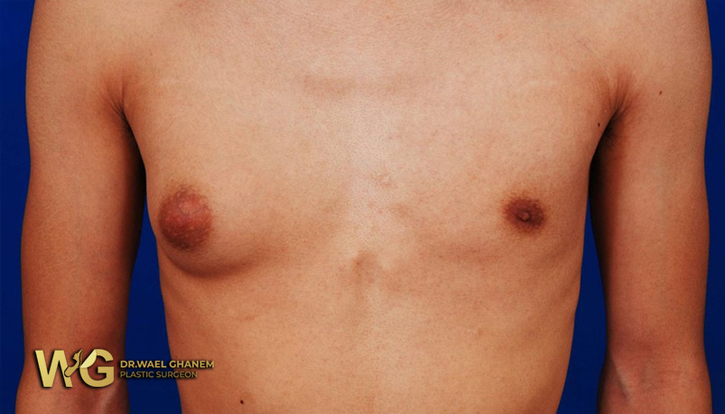 اختلاف حجم الثديين عند الرجال.. الأسباب والأعراض وطرق العلاج