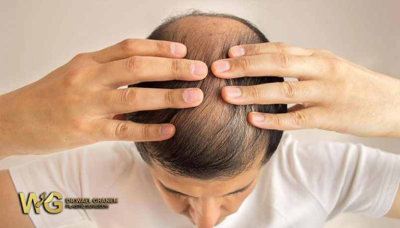 زراعة الشعر..لتوديع الصلع نهائياً وزيادة كثافة الشعر