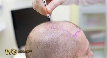 طرق زراعة الشعر وحمايته من التساقط