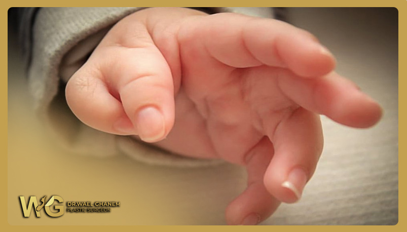 الاصابع الزائدة أكثر العيوب الخلقية بين حديثي الولادة