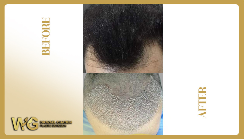 زراعة الشعر لمظهر شبابي دائم