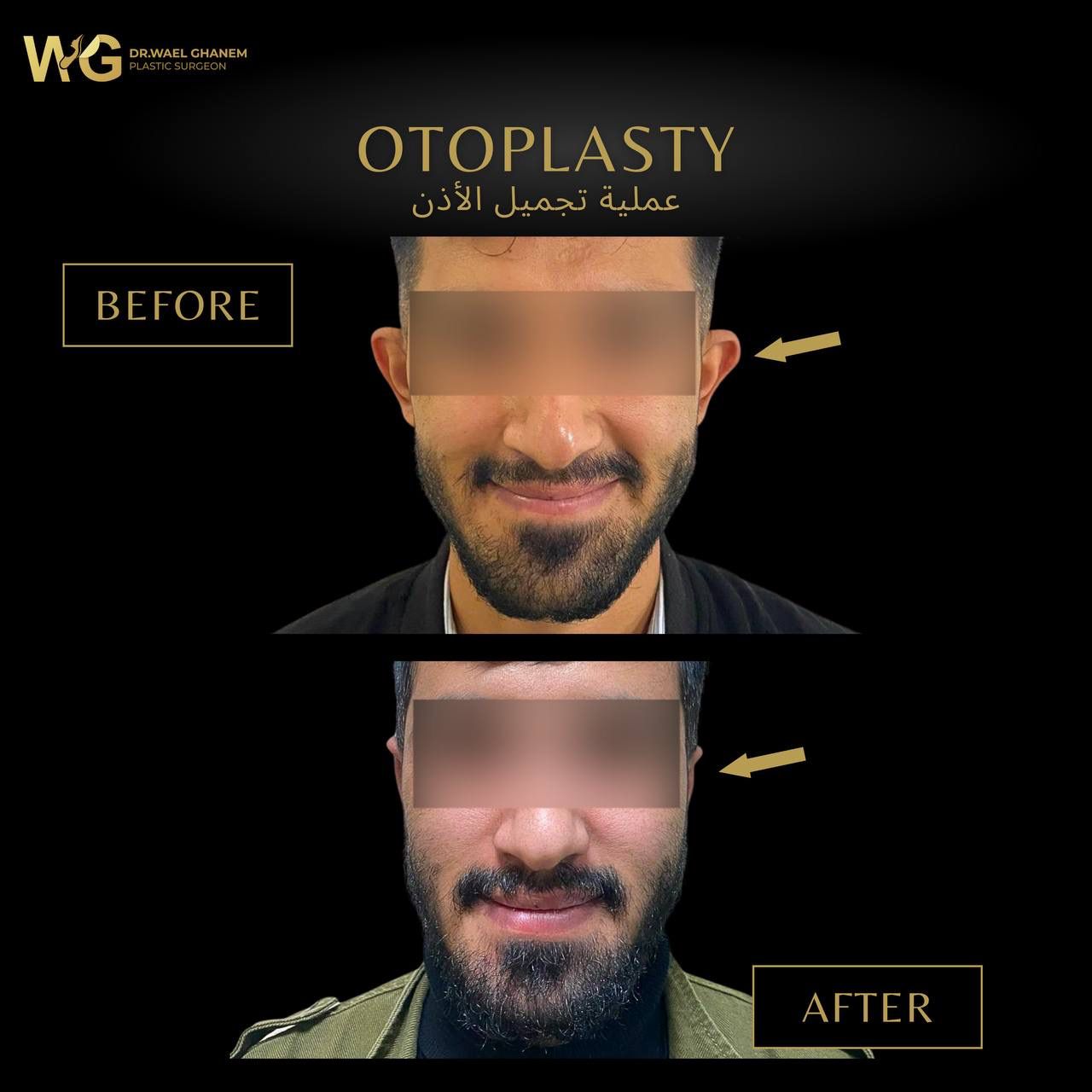 تجربتي-مع-عملية-تجميل-الأذن