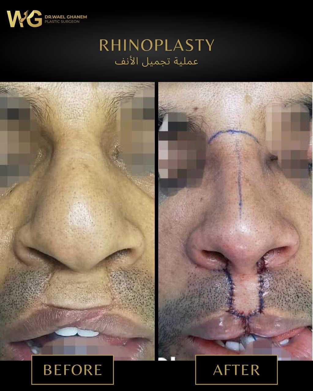 عملية-تجميل-الانف-للرجال